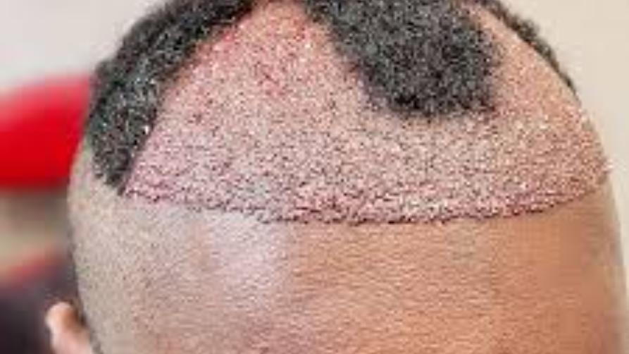 Hva er hårtransplantasjon?