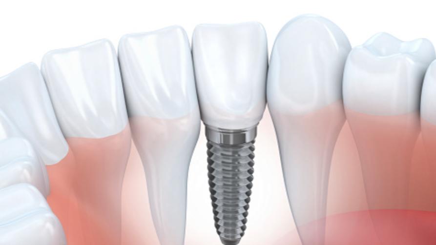 Co je to zubní implantát?