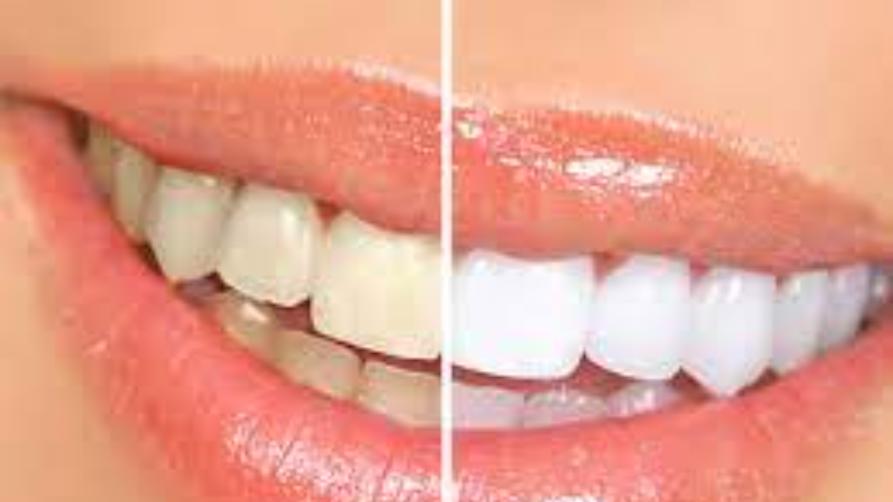 Câu hỏi về làm trắng răng