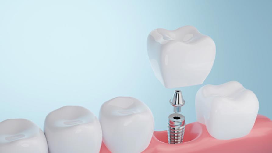Перавага імплантацыі зубоў у Турцыі