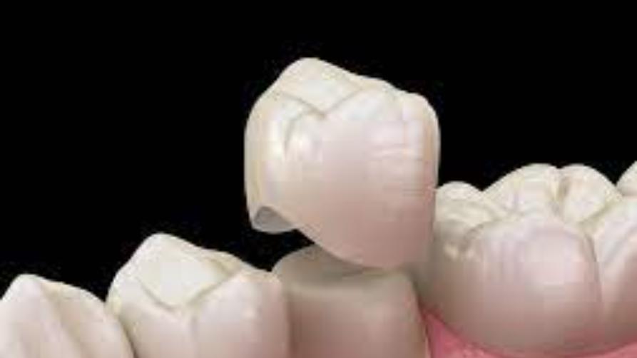Quanto dura la vita di una corona dentale?
