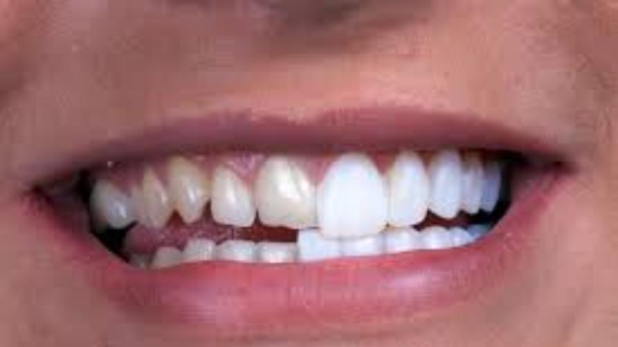 As carillas dentais máis asequibles no estranxeiro