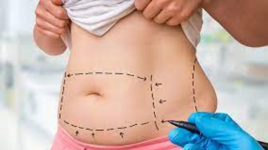 360 Degree Liposuction i Turkey