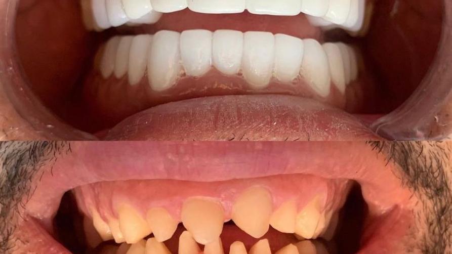 Goedkoop tandheelkundige behandeling in Turkye: kwaliteit tandheelkundige behandeling opsies