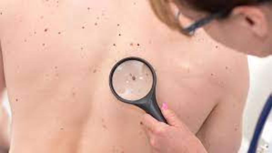Какво е рак на кожата?