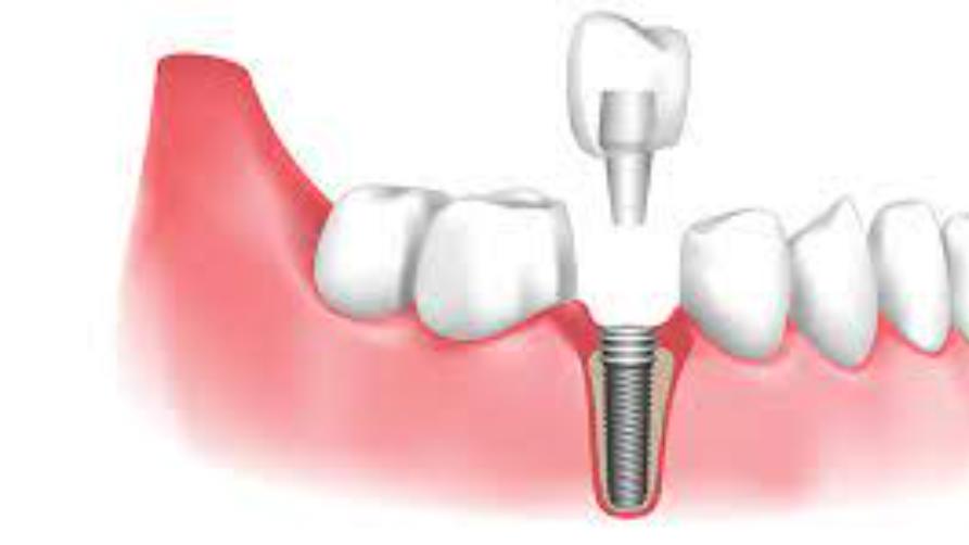 Vidin'ny implants dental any Washington, Etazonia