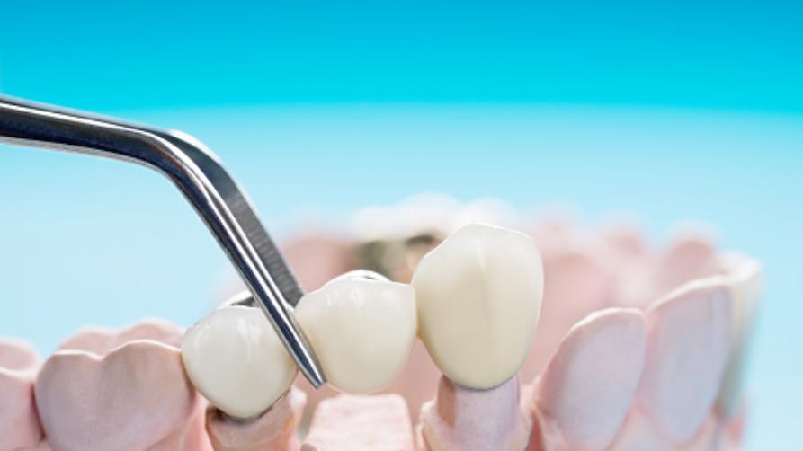 Prezzi delle faccette dentali a Varna: dovrei acquistare le faccette E-max a Varna, in Bulgaria?
