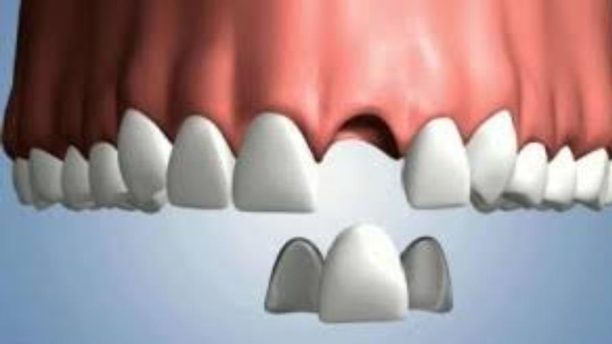 K čemu slouží zubní můstek?