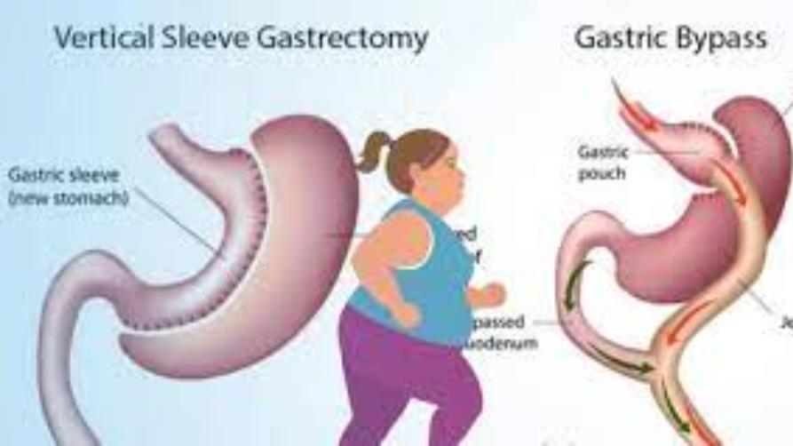 Gastrisk bypass kirurgi ernæringsmønster
