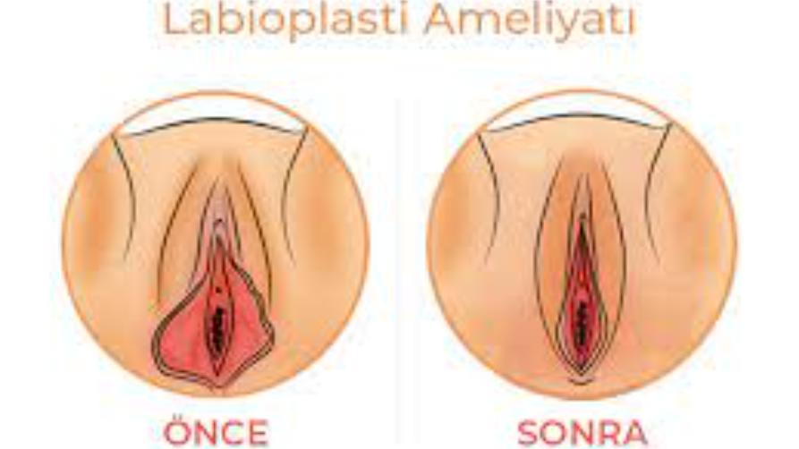 Labioplasti Yağ Enjeksiyonu Nedir?