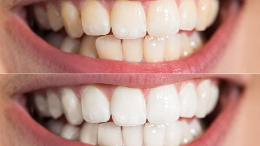 Co je bělení zubů?