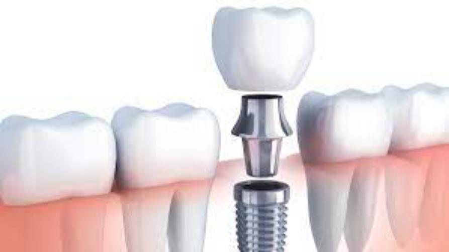 Што такое зубны імплантат All On 4?