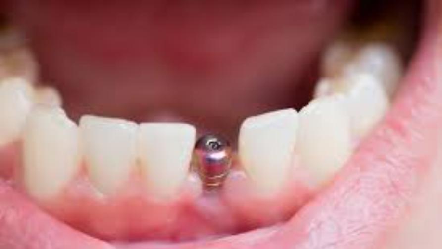 Istanbul Dental Implant Tau