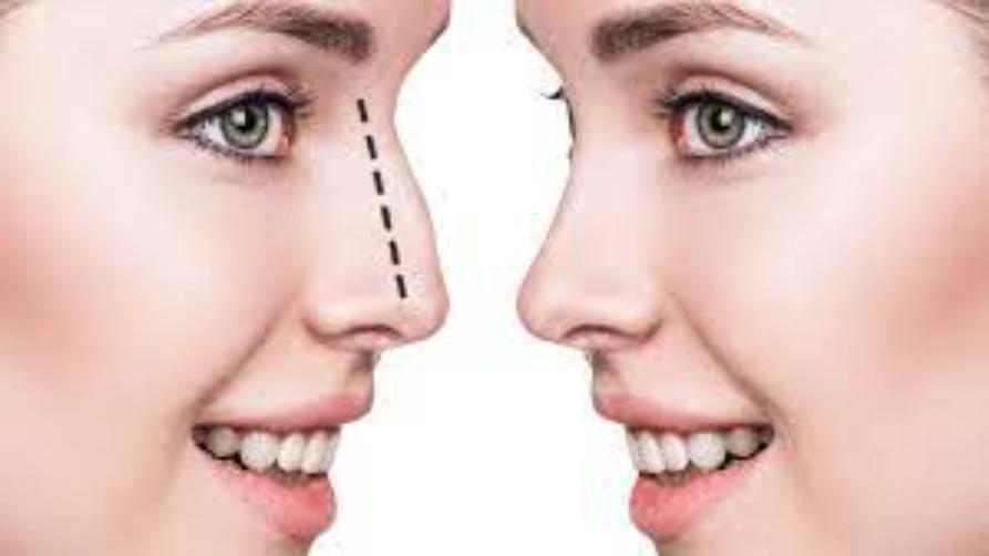 鼻形成術とは何ですか?なぜそれが行われるのですか?