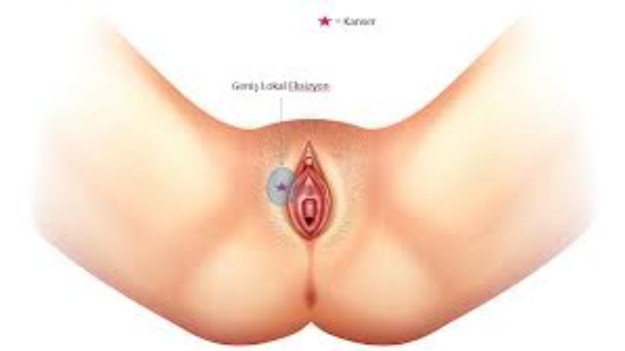 Què és l'alleugeriment de la vulva?