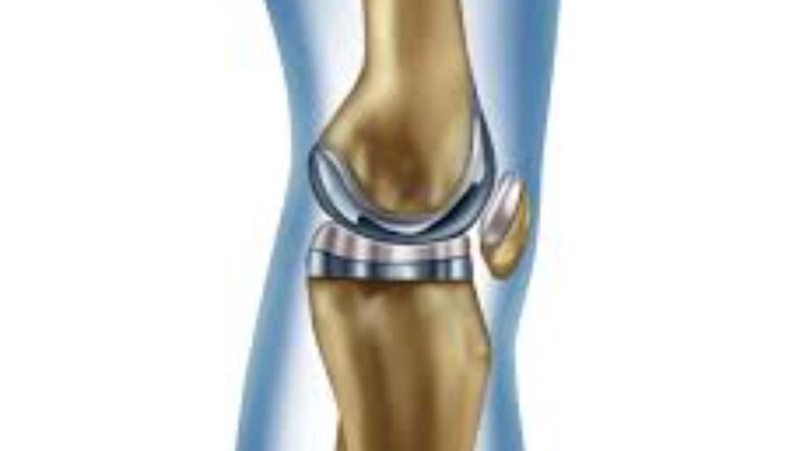 Pembedahan Gantian Lutut