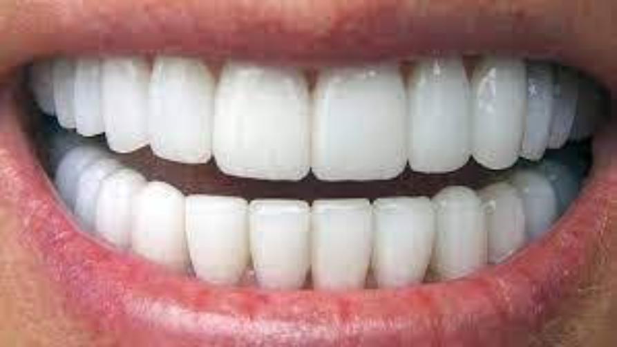 Кое е по добре? Зъбни фасети Корони и цени в Турция