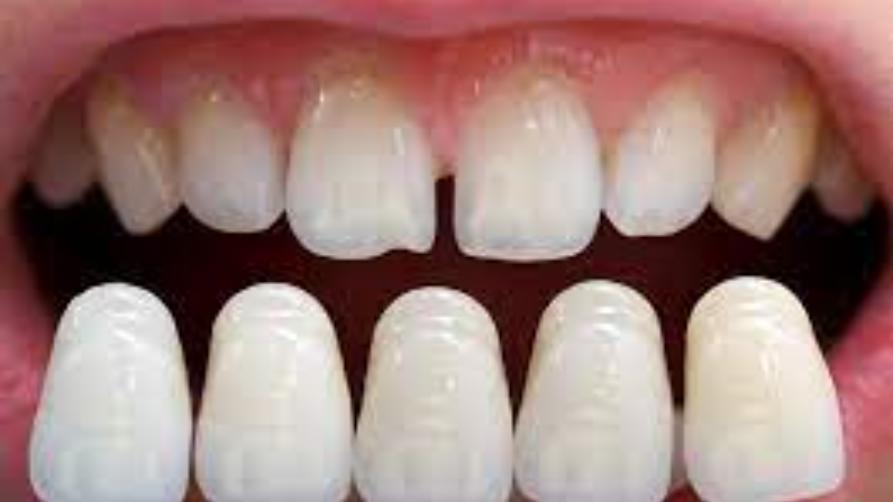 Crowns dental di Turki