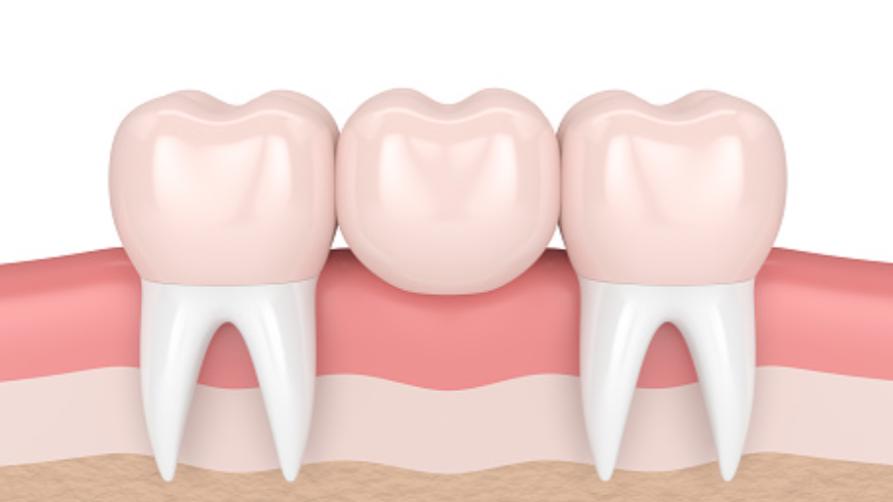 Що таке зубний міст?
